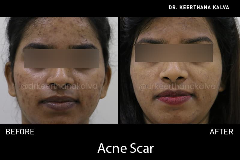 Acne scars — before and after
