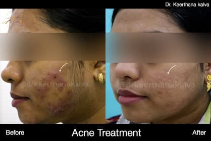 Active acne — before and after