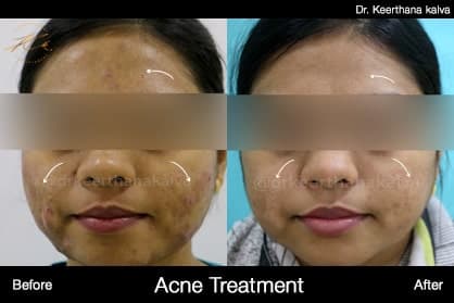 Acne & post-acne marks — before and after